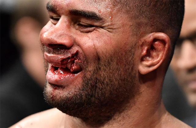 That Overeem Lip Cut: The Worst Injury in UFC History? (Fighters Lip Split in Half)