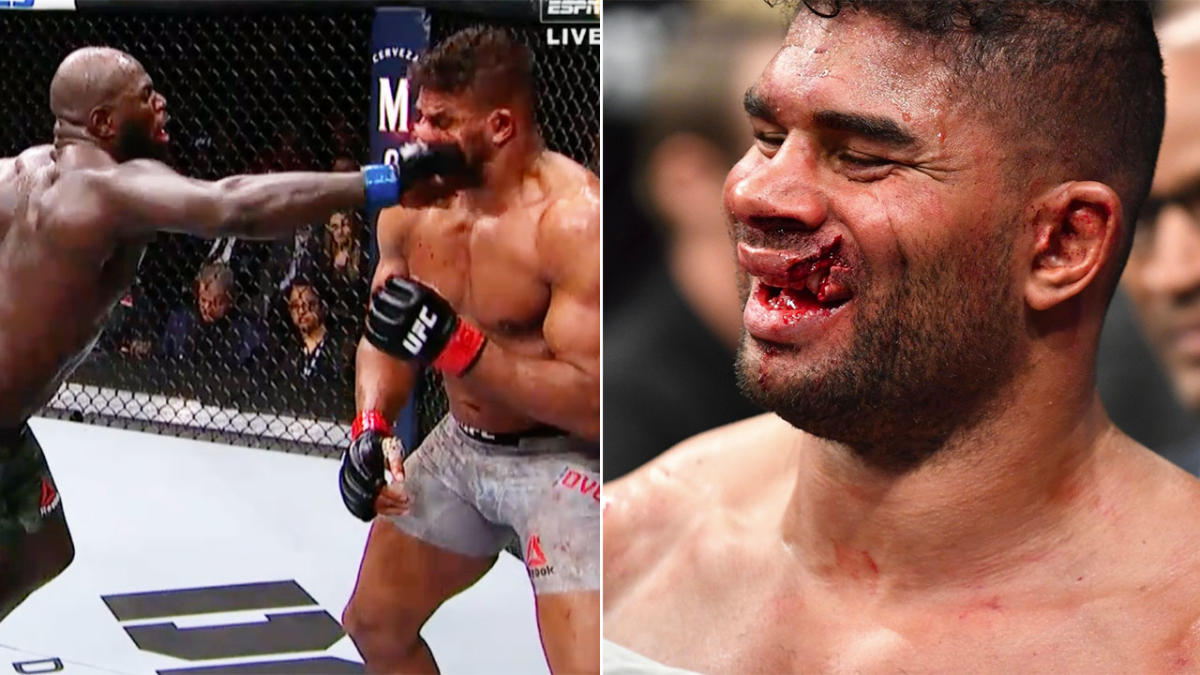 That Overeem Lip Cut: The Worst Injury in UFC History? (Fighters Lip Split in Half)