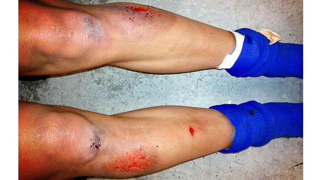 Ouch! Turf Burn Hurts: How to Deal With Turf Burn and Heal Quickly