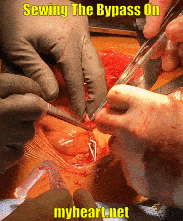 Need pictures of heart surgery? See what the actual procedure looks like with these clear photos.