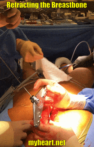 Need pictures of heart surgery? See what the actual procedure looks like with these clear photos.